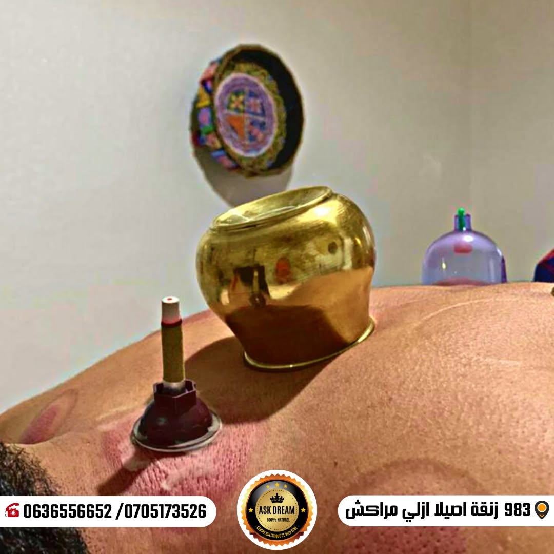أدوات الحجامة الطبية المستعملة بالمركز